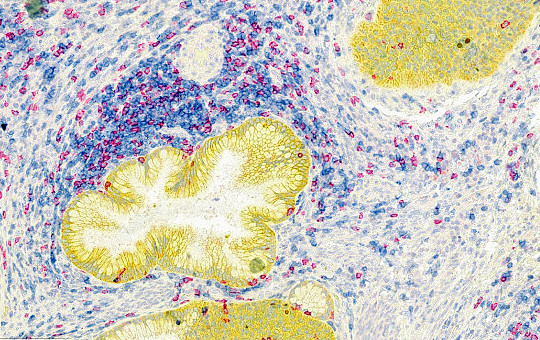Uterine Cervix Squamous Cell Carcinoma: CD4, CD8, PanCK 15x